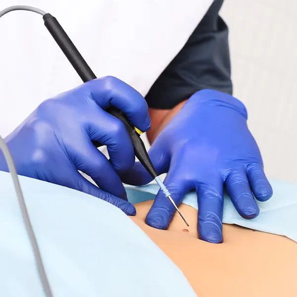 Img-Centro_Estetico_Mediluxe-Servicios-Card_Home-Cauterización