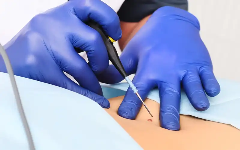 img-cauterizacion-de-verrugas-en-bello-1-LCP
